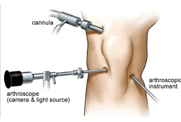 Arthroscopic Surgery