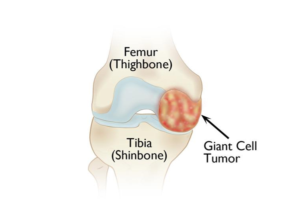 Orthopaedic Tumors