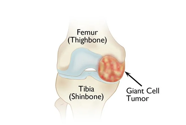 Orthopaedic Tumors